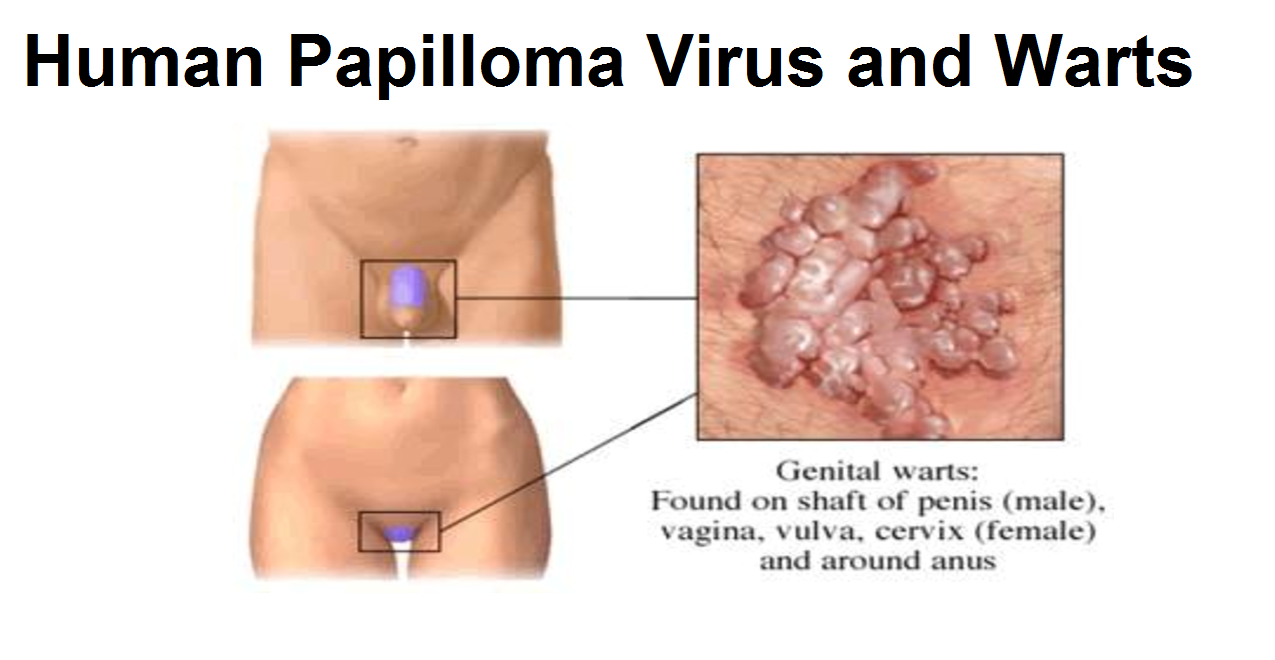 hpv and genital herpes prevenirea eficientă a viermilor